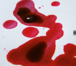 Manchas de sangue sobre um tecido branco.